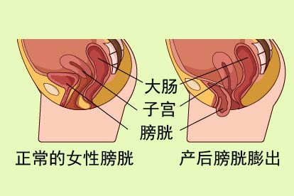 产后膀胱膨出图片