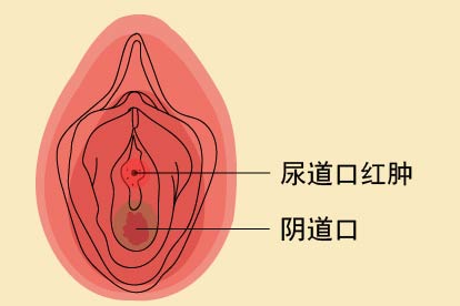 尿道口红肿图片