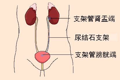 尿结石支架图