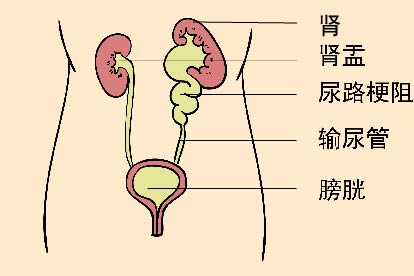 尿路梗阻图