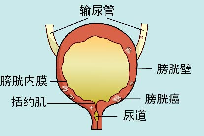 晚期膀胱癌图片