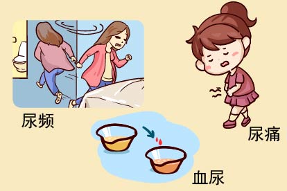 膀胱癌症状图片
