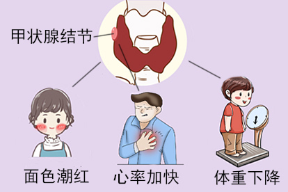 甲状腺结节图片