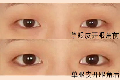 单眼皮开眼角对比图