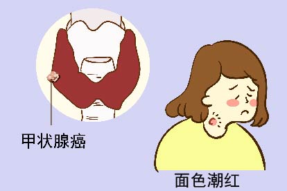 甲状腺癌面色潮红图片