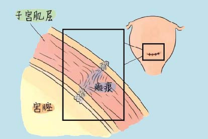 子宫瘢痕妊娠图片