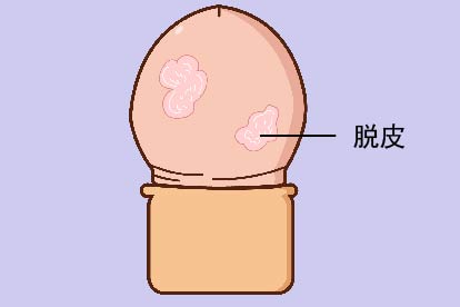 包茎术后龟头脱皮图