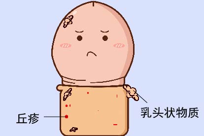 包皮息肉图片