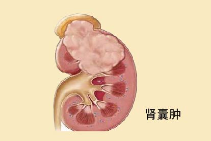 肾囊肿图