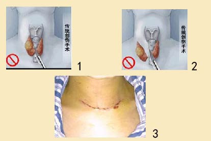 甲状腺口腔过程图片