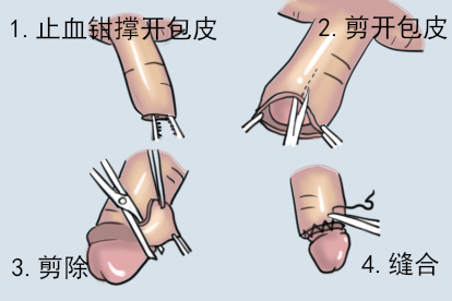 包皮环切术图片