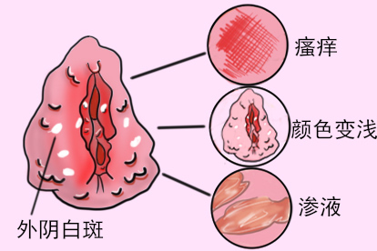 什么是外阴白斑，什么症状图片