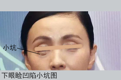 下眼睑凹进去一个小坑图片