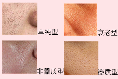 4种毛孔粗大图