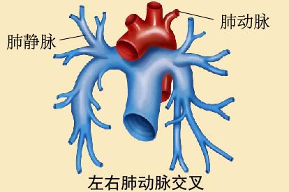 左右肺动脉交叉解剖图