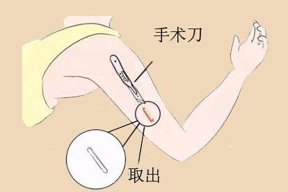 埋线避孕取出图片