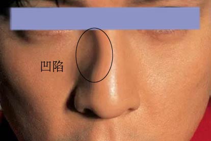 隆鼻后鼻梁一侧凹陷图片