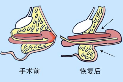小孩做了隐匿性阴茎手术怎样才算恢复好图片