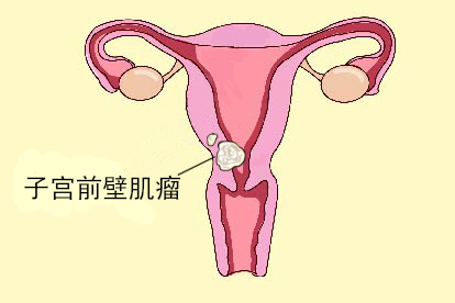 子宫前壁肌瘤图片