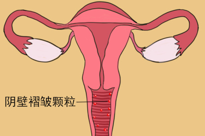 阴壁褶皱颗粒图