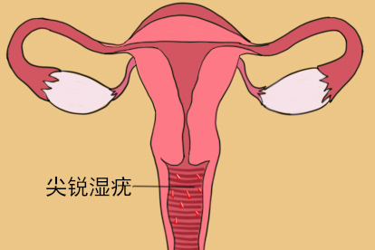 阴壁尖锐湿疣图