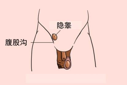 左侧隐睾在腹股沟图片