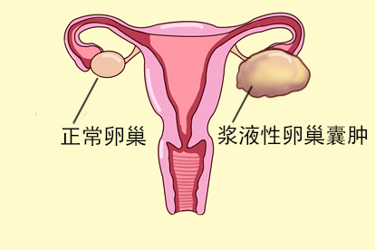 浆液性卵巢囊肿图