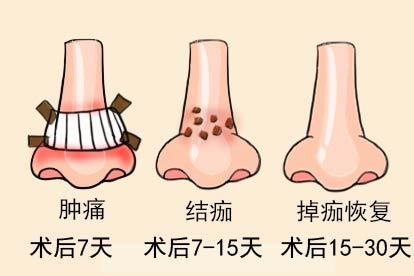 鼻子植皮术恢复图