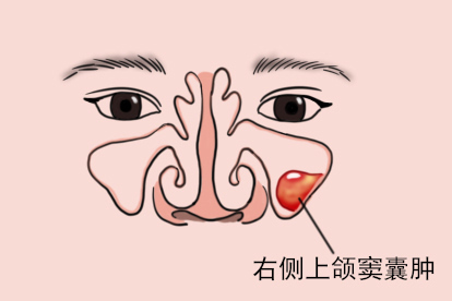 右侧上颌窦囊肿图