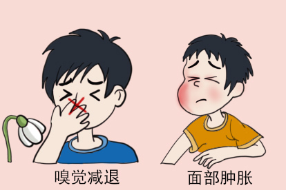 上颌窦囊肿症状图