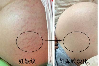 妊娠纹淡化图
