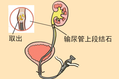 输尿管结石排出图
