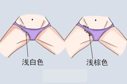 腹股沟汗斑图片