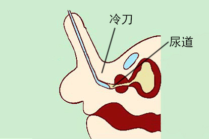 尿道狭窄术图片