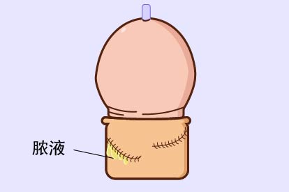 尿道下裂术后感染图