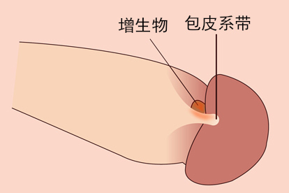 包皮术后肉疙瘩图