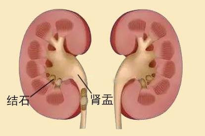肾盂结石图片