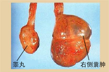 睾丸囊肿图片