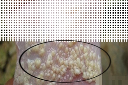 包皮龟头炎图片