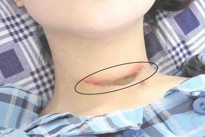 甲状腺手术后伤口图