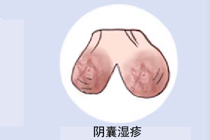 阴囊湿疹图