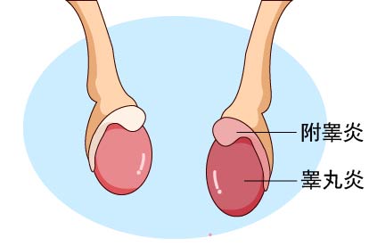 病理性阴囊发硬图