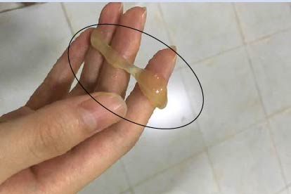 产后排出液体图片