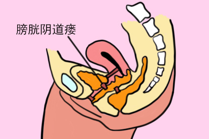 膀胱阴道瘘图片