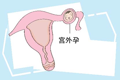 宫外孕图片