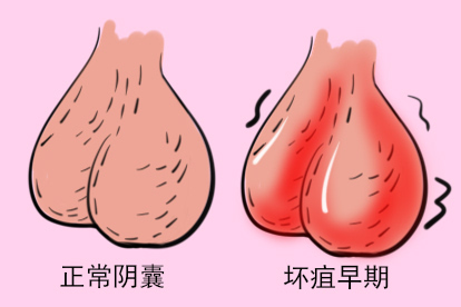 阴囊坏疽早期图片