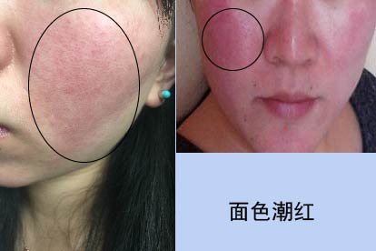 面色潮红图片