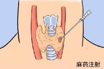 甲状腺麻药注射