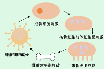前列腺癌骨转移图