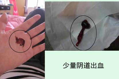 先兆流产图片